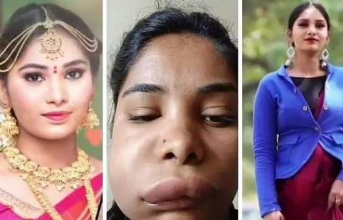  പല്ലില്‍ റൂട്ട് കനാല്‍ ശസ്ത്രക്രിയ ചെയ്ത കന്നഡ നടിയുടെ മുഖം തിരിച്ചറിയാനാകാത്ത അവസ്ഥയില്‍; ശസ്ത്രക്രിയയിലെ ഗുരുതര പിഴവ് മൂലം മുഖം വികൃതമായതോടെ വീടിന് പുറത്തിറങ്ങാതെ കഴിയുന്നത് നടി സ്വാതി സതീഷ്